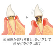 歯周病治療