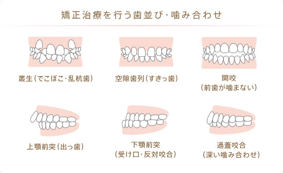 矯正治療を行う歯並び・噛み合わせ